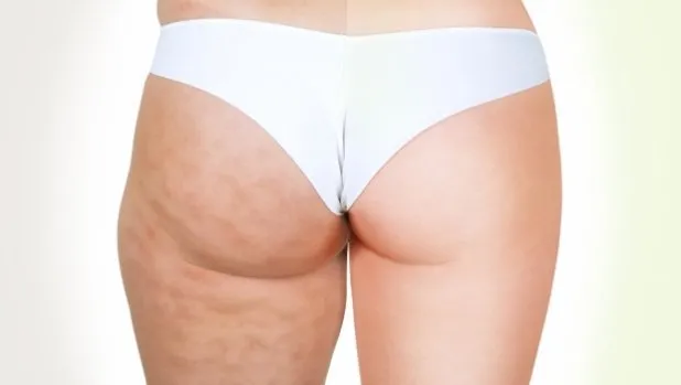 Cum sa scapi de celulita in 5 pasi