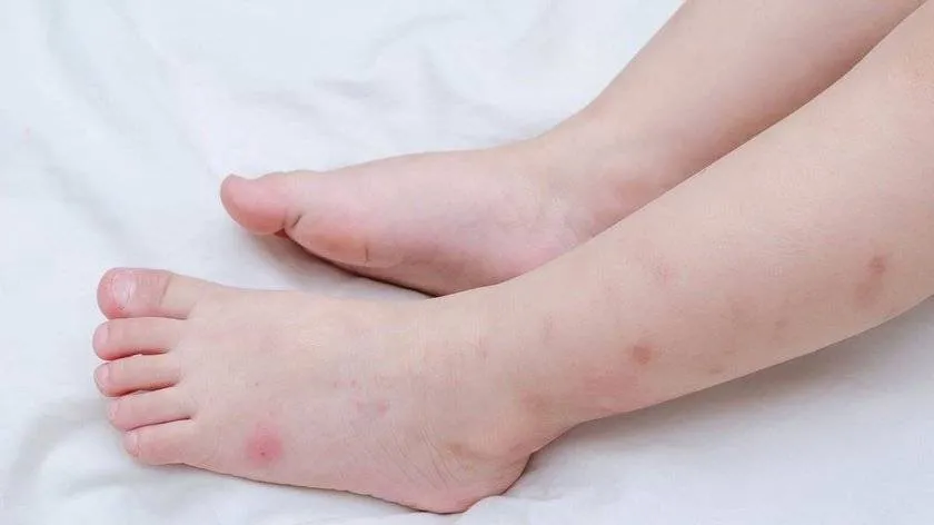 Intepaturile de insecte: Cum iti feresti bebelusul de ele