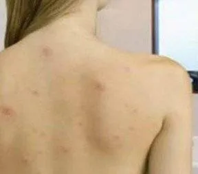 Nu poti sa iti expui spatele din cauza cosurilor? Iata cum poti scapa de ele fara sa iti ramana cicatrici