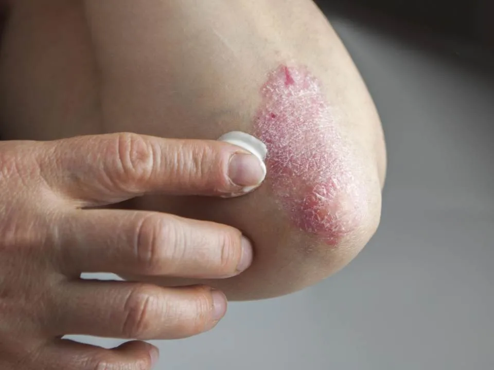 Cum sa scapi de o eczema pe cale naturala