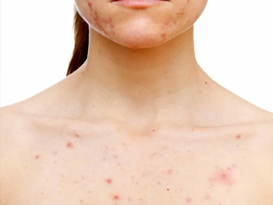 Cum sa scapi de acneea de pe piept folosind aceste trei ingrediente