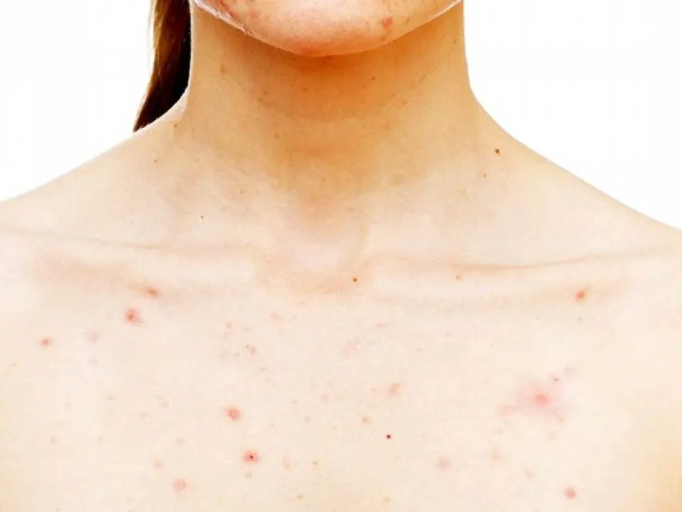 Remedii naturale pentru acneea de pe piept