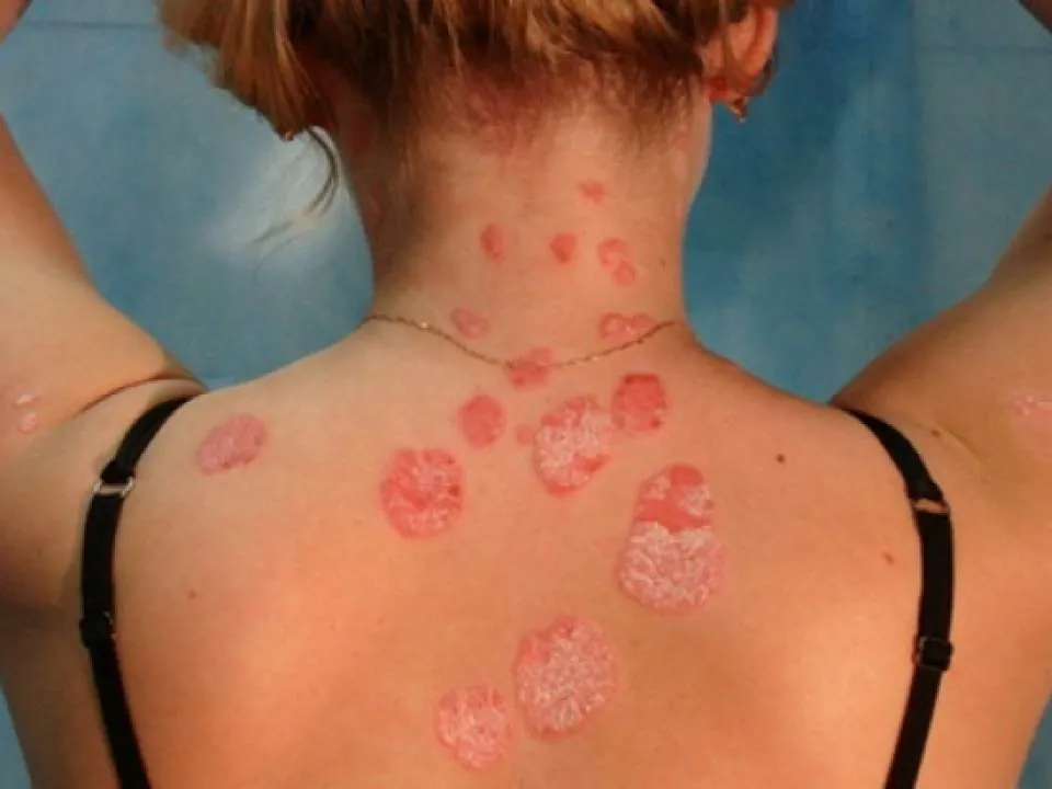 Remedii pentru psoriazisul scalpului