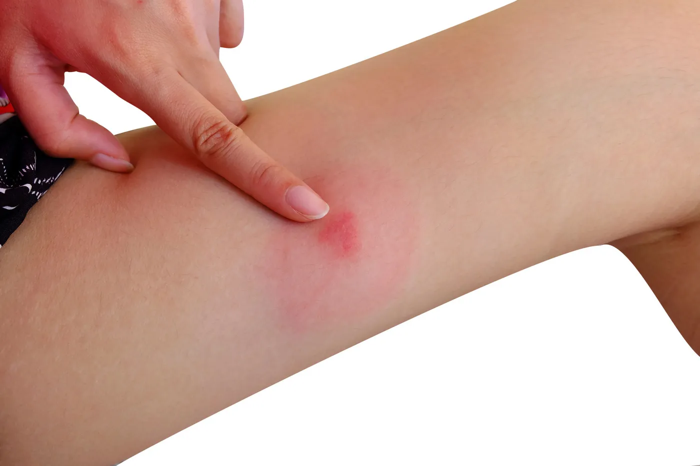 Tratarea muscaturilor de insecte la copii