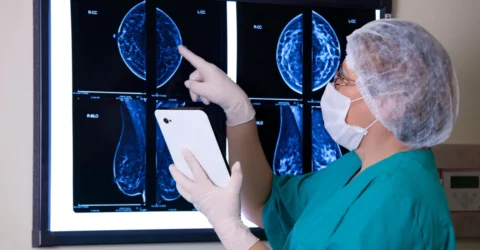 Riscul de cancer la sân crește la 15% pentru femeile cu sâni denși