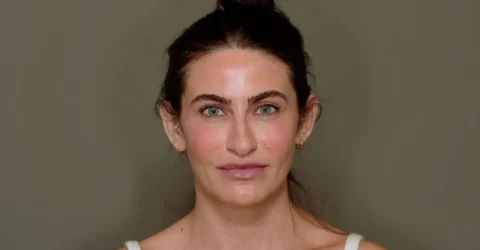 Grefa de grăsime facială – doar 50% din celule supraviețuiesc transferului