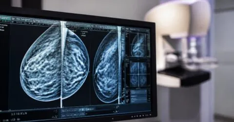 Cancerul de sân, depistat mai precis cu ajutorul inteligenței artificiale. Mamografia ar putea urmări riscul în timp
