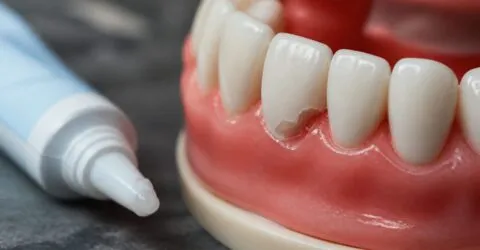 Cercetătorii de la Universitatea din Nottingham au creat un gel dentar pentru regenerarea smalțului