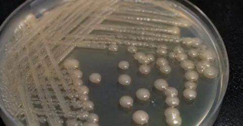 Bacteria Klebsiella pneumoniae a evoluat doi ani într-o femeie de 63 de ani