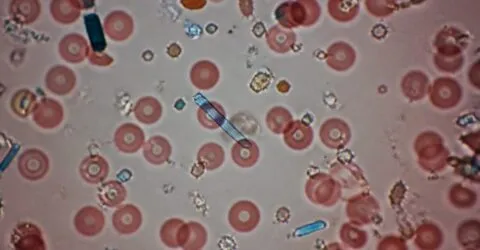 Microplasticele au fost găsite la 84% dintre pacienții cu infarct sever