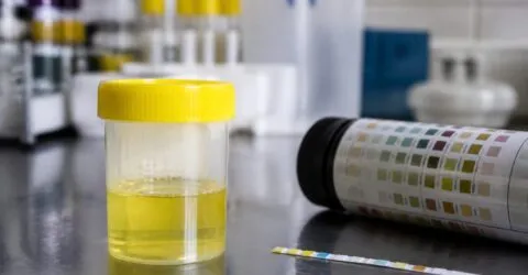 Proteinele în urină nu înseamnă mereu boală. O valoare de sub 1g/zi poate reveni la normal după o schimbare de stil