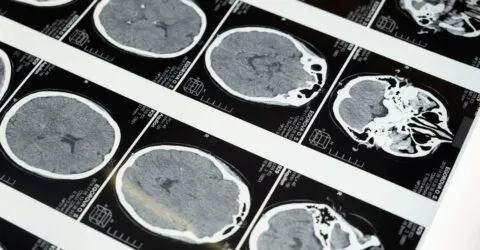 Un AVC poate începe fără paralizie. Cum recunoști schimbările bruște care cer ajutor medical imediat